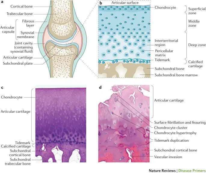 Osteoarthritis: therapeutic dressings to repair joints