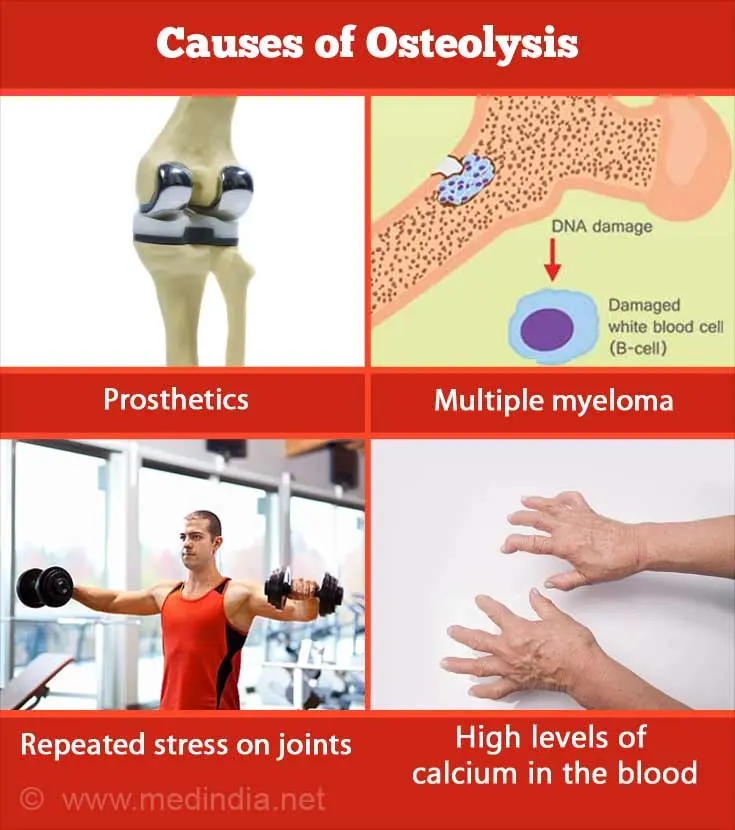 Osteolysis: definition, symptoms and treatments