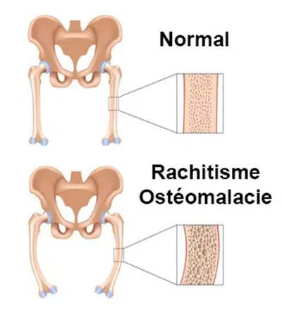 Ostéomalacie