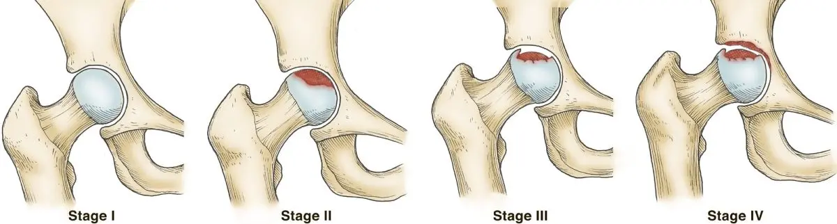 Osteonecrosis of the hip, knee, head: how to treat it?