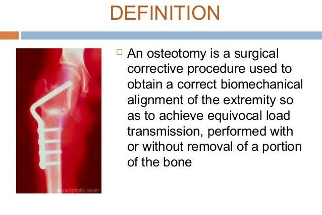 Osteotomy: kahulugan