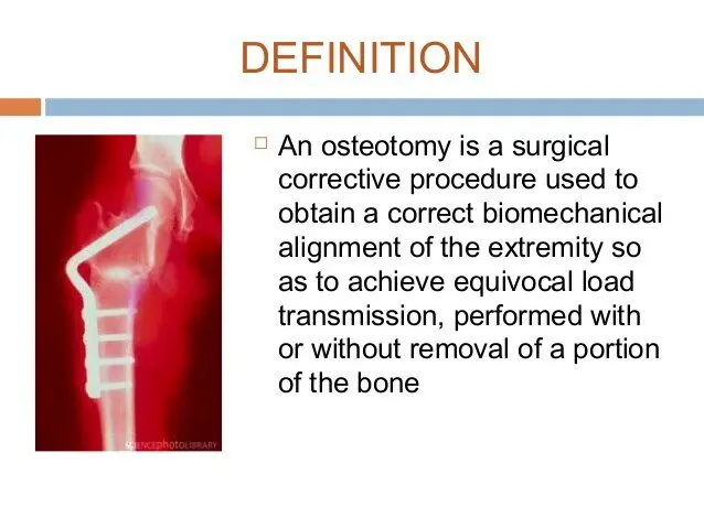 Osteotomy: definition