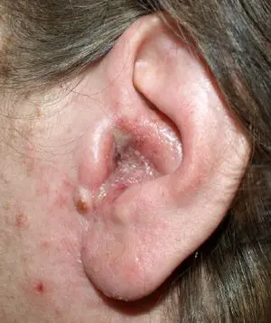 Otitis externa, what is it?