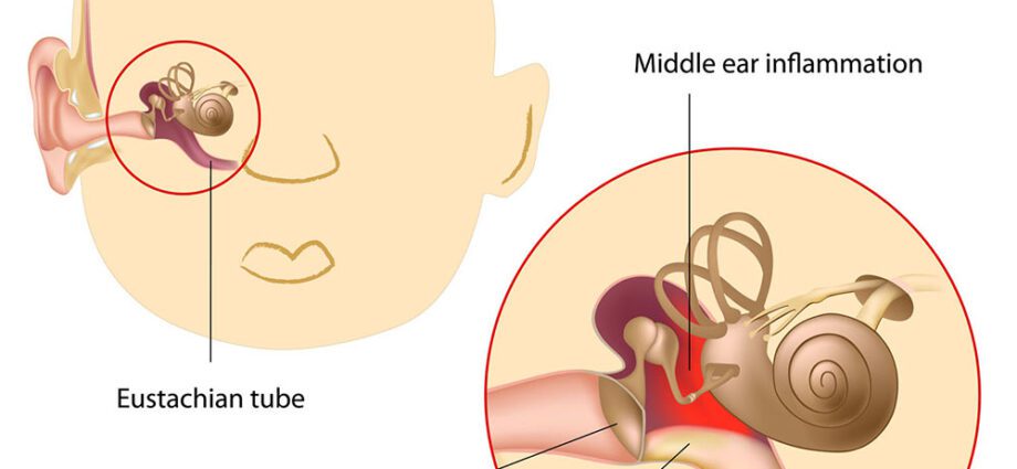 Zapalenie ucha środkowego: wszystko, co musisz wiedzieć o zapaleniu ucha u dzieci i dorosłych