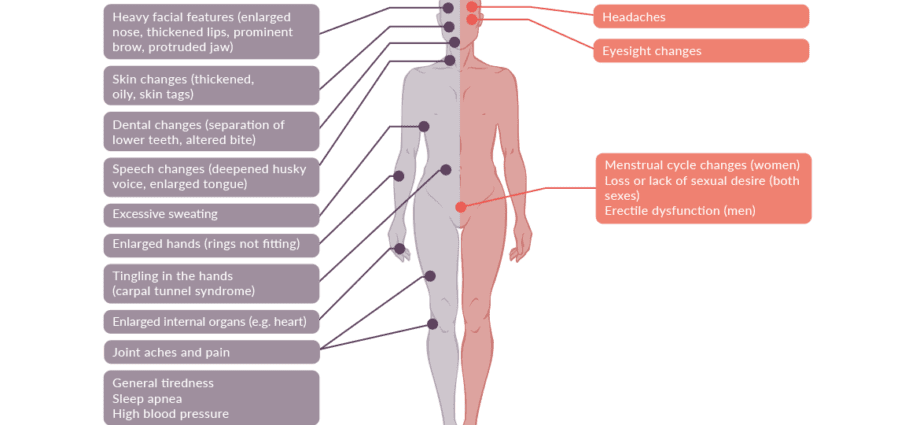 Our doctor&#8217;s opinion about acromegaly