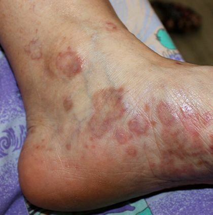Our doctor&#8217;s opinion about lichen planus