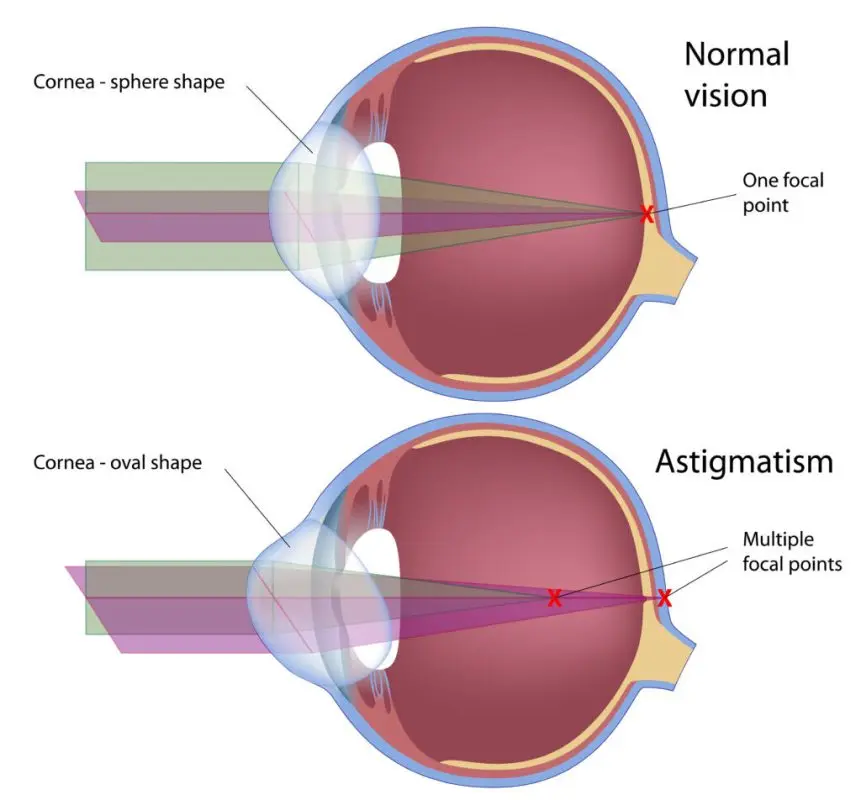 Our doctor&#8217;s opinion on astigmatism