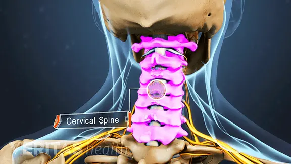 Pain in the neck and spine, how to treat osteochondrosis: doctor&#8217;s advice