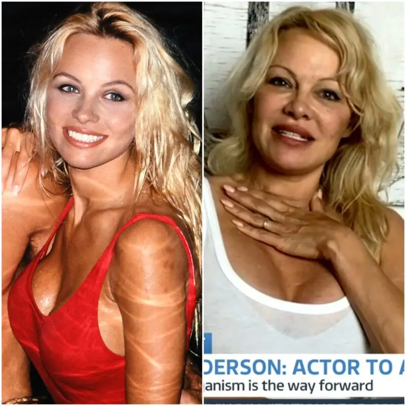 Pamela Anderson before and after plastic surgery photo