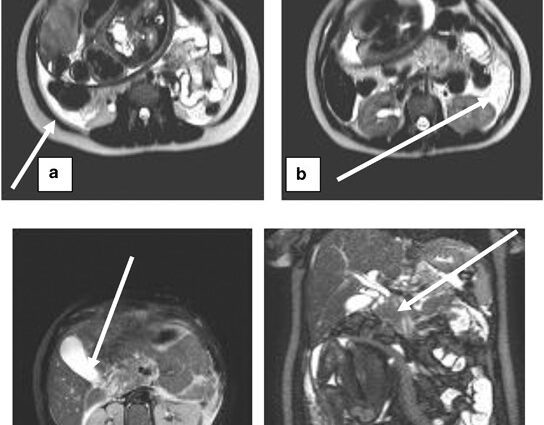 Pancreatitis during pregnancy