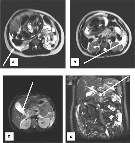 Pancreatitis during pregnancy