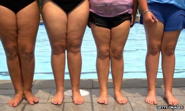 Parents brought their daughter to obesity