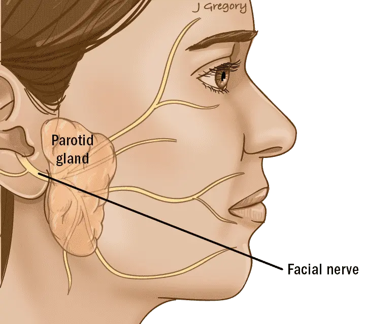 Parotidectomy