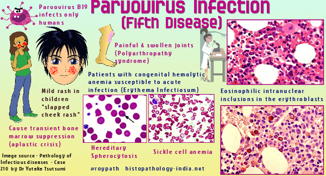 Parvovirus B19: රෝග ලක්ෂණ සහ ප්‍රතිකාර