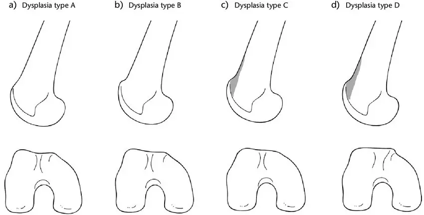 Patellofemoral dysplasia