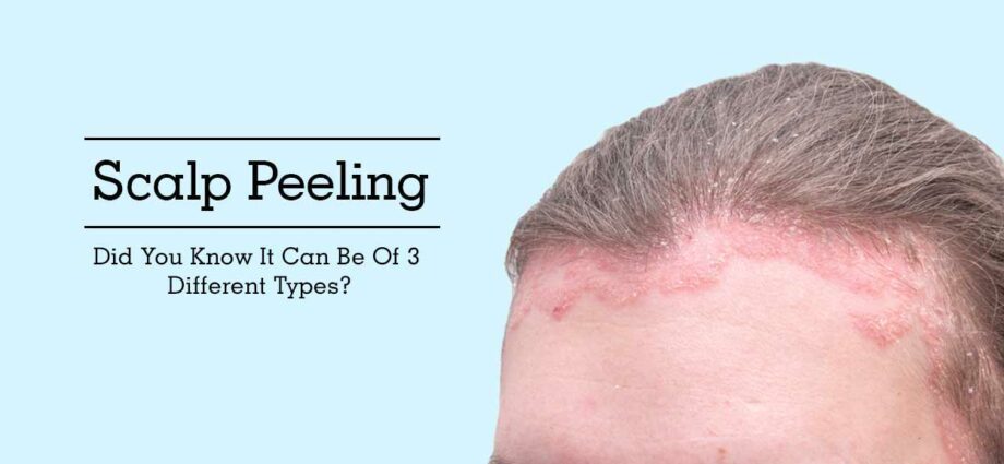 Peeling of the scalp: how to get rid of? Video