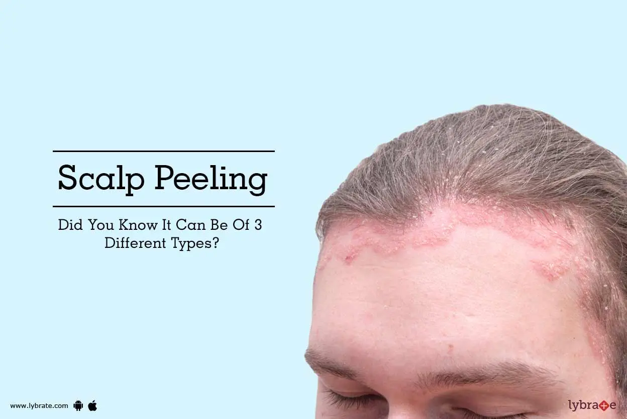 Peeling of the scalp: how to get rid of? Video