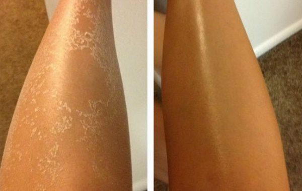 Peeling de la piel de las piernas: causas y tratamiento. Video