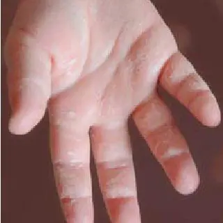 Peeling of the skin on the palms: what to do? Video