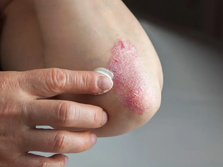 Peeling skin on the elbows: what to do. Video