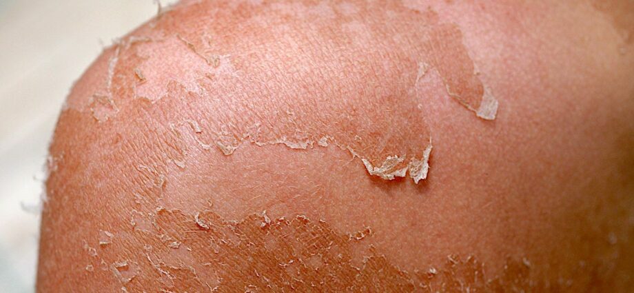 Peeling: what should you know?