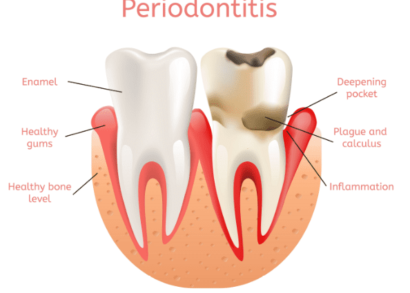 Periodontics