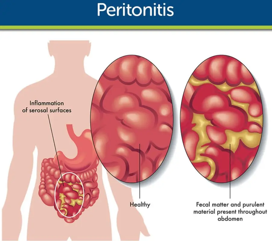 Peritonitis: symptoms and treatments