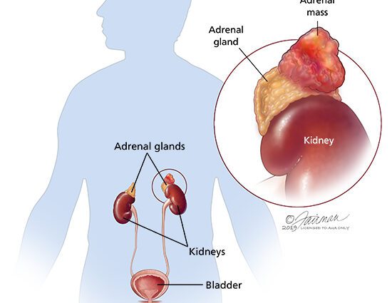 Pheochromocytomas: understanding diseases of the adrenal medulla