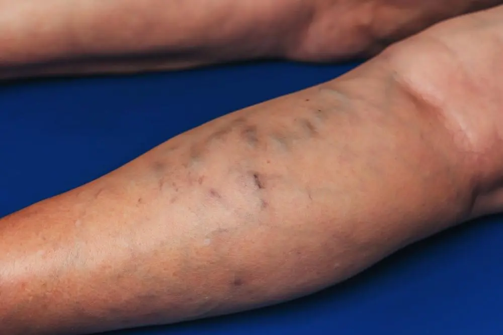 Phlebitis