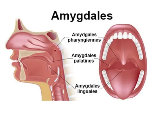 Phlegmon amygdalien