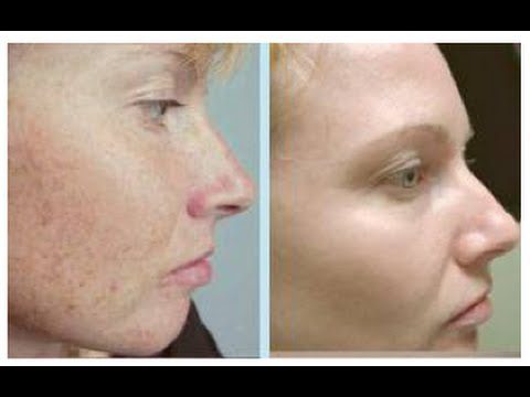 Photorejuvenation of the face: reviews. Video