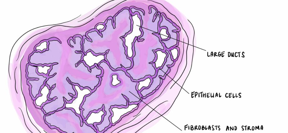 Phyllodes tumör