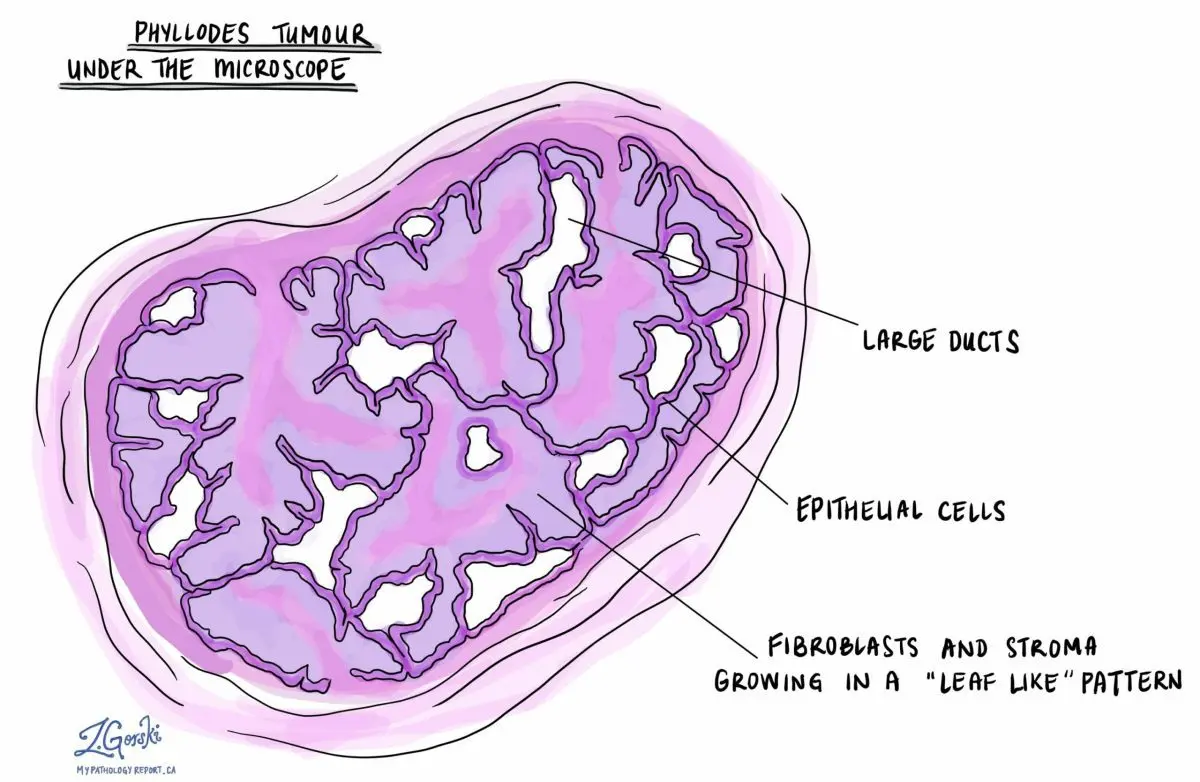 Phyllodes tumor