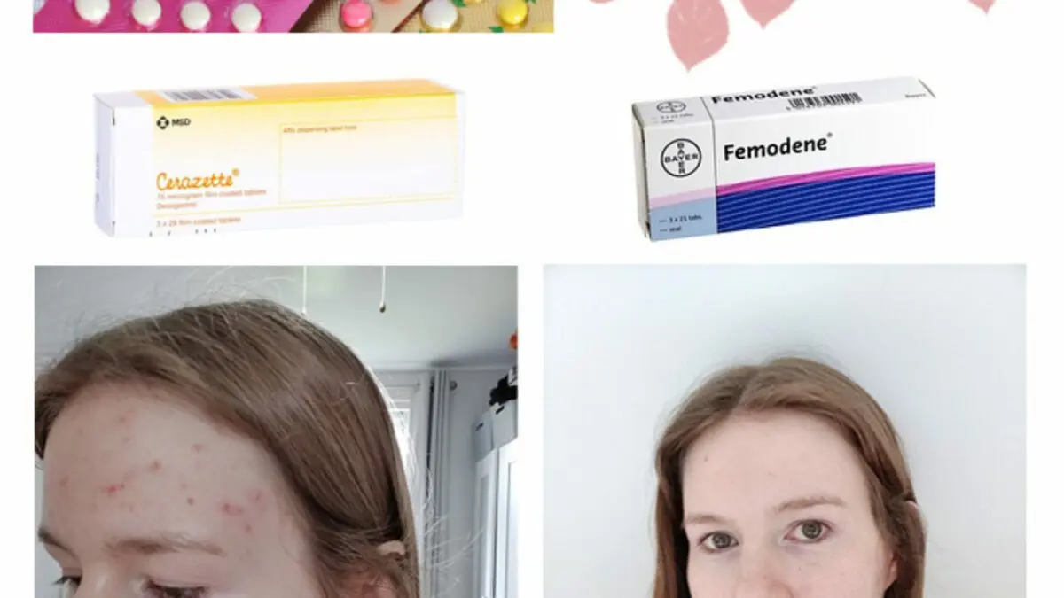 Pills for acne on the face: reviews