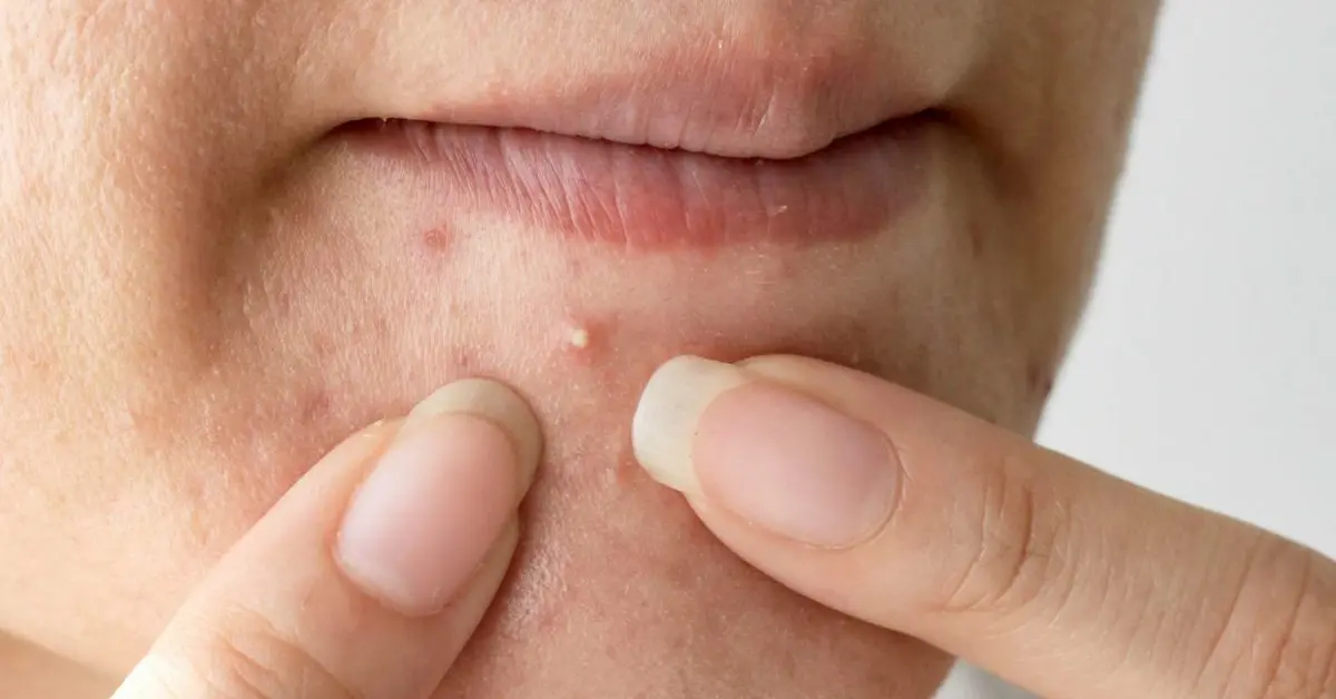 Pimple on the chin: where do these pimples on the face come from?