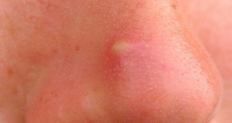 Bouton sur le nez : acné ou autre dermatose ?