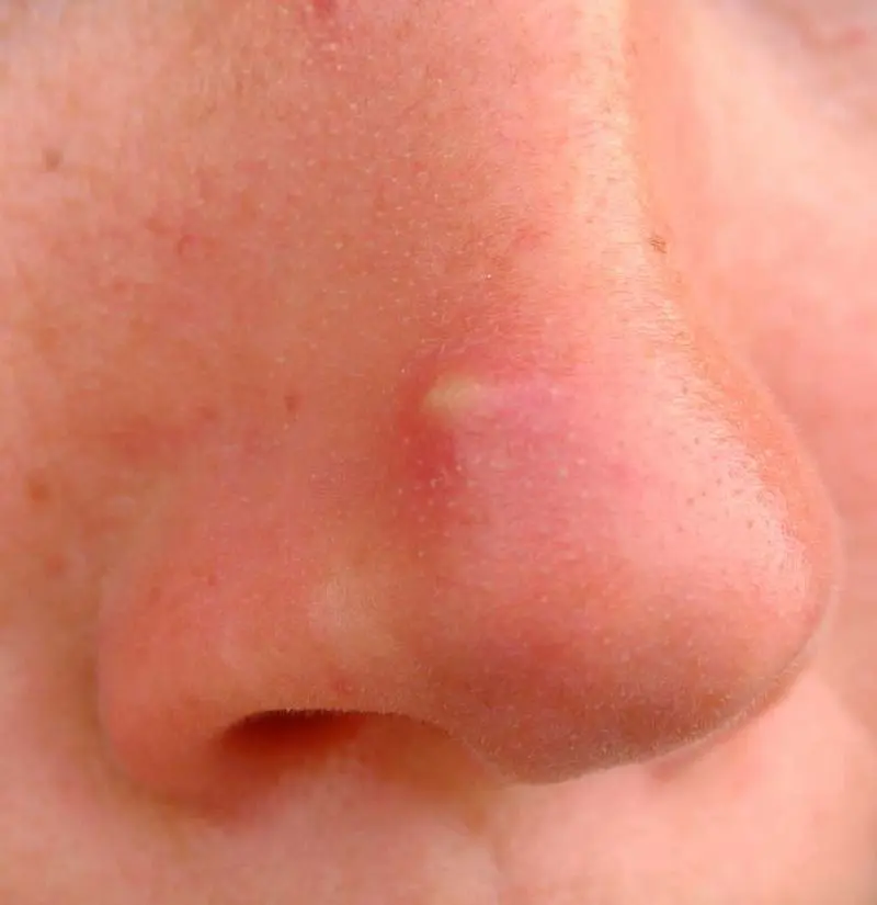 Pimple on the nose: acne or other dermatosis?