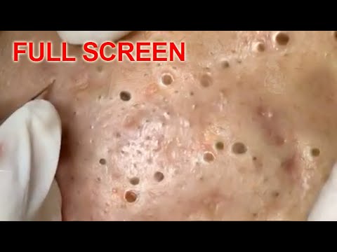 Pimples from acne: how to remove? Video