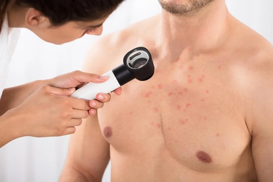 Pimples on the chest and back: how to get rid of? Video