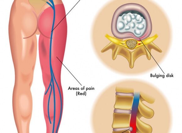 Pinched sciatic nerve during pregnancy, symptoms