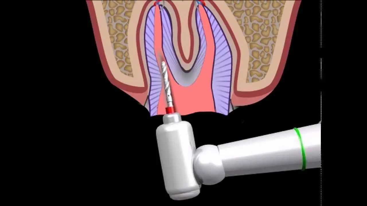 Pivot tooth (pivot tooth)