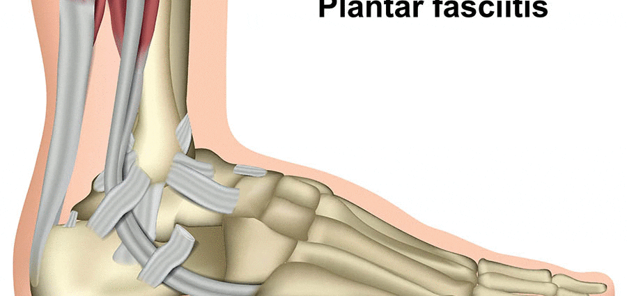 Plantar fasciitis and the heel spur
