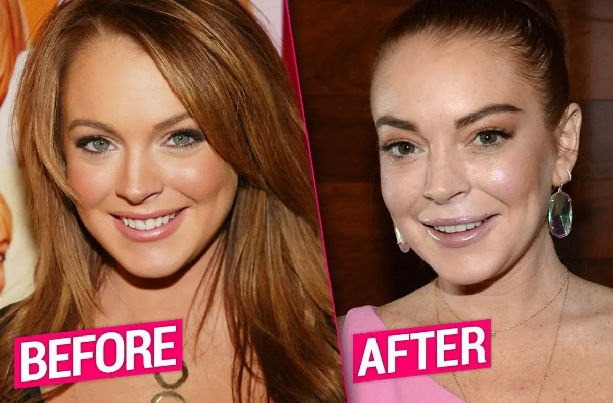 Plastic surgery Lindsay Lohan