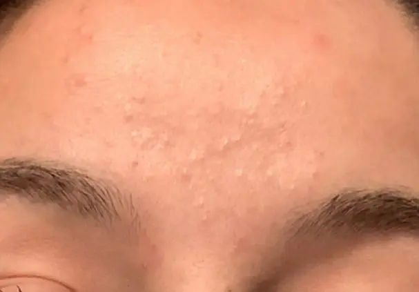 Point blow: how to cure comedones?