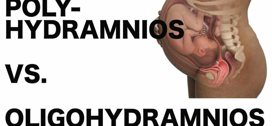 Polyhydramnios during pregnancy. Video