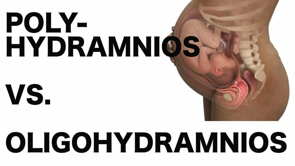 Polyhydramnios during pregnancy. Video