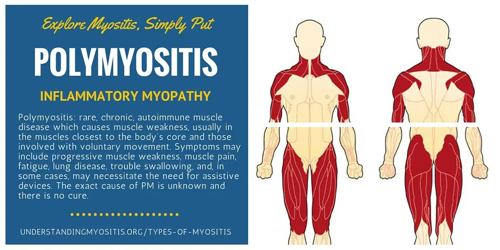 Polymyositis: causes, symptoms, treatments