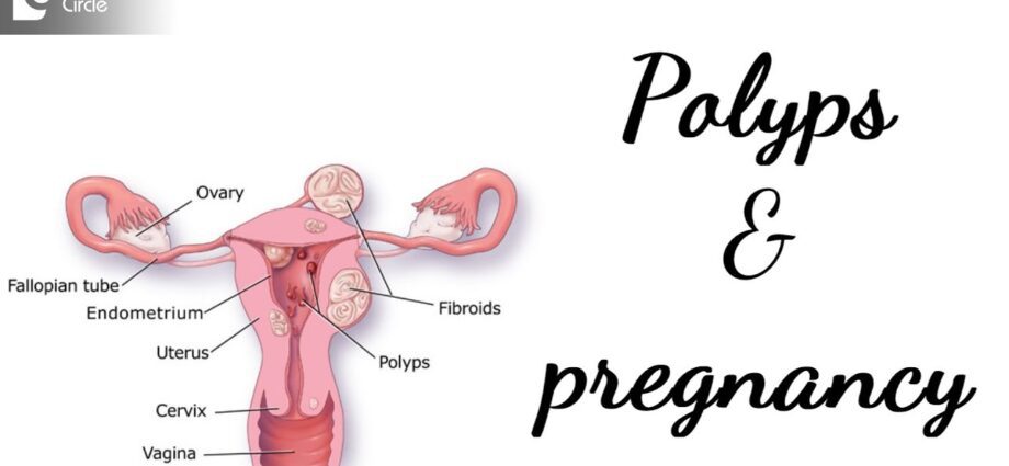 गर्भावस्था के दौरान पॉलीप्स; पॉलीप हटाने के बाद गर्भावस्था