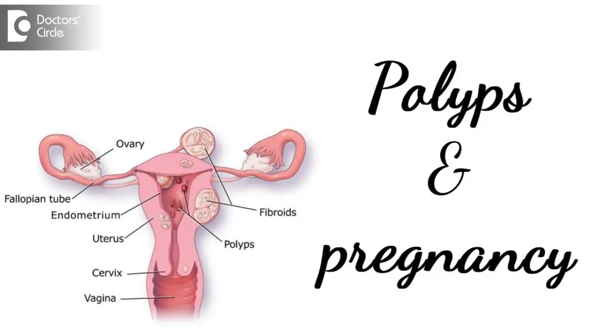 Polyps during pregnancy; pregnancy after polyp removal