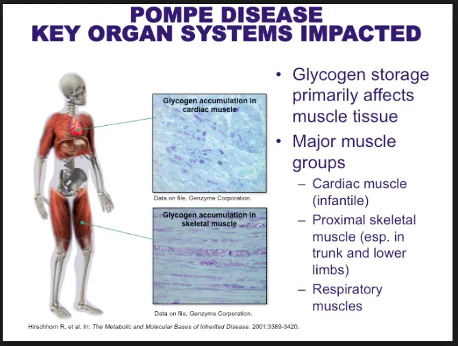 Pompe disease